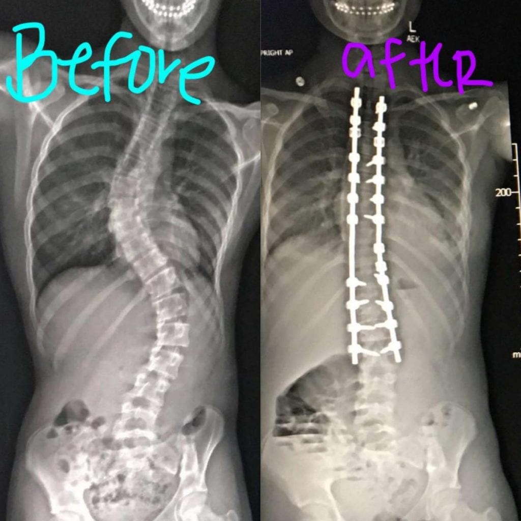 scoring on scoliosis Dayton Children's Hospital